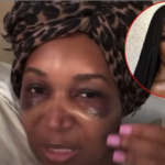 Marlo Hampton, Surgery, Hair, Transplant, Procedure,