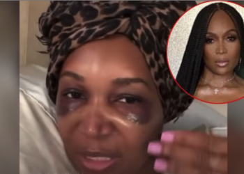 Marlo Hampton, Surgery, Hair, Transplant, Procedure,
