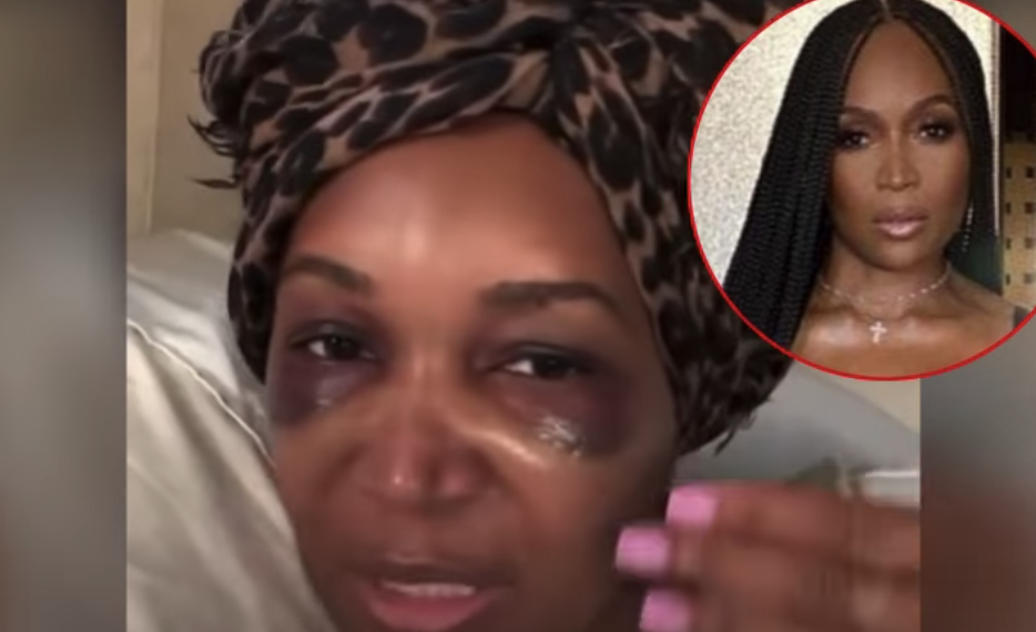 Marlo Hampton, Surgery, Hair, Transplant, Procedure,