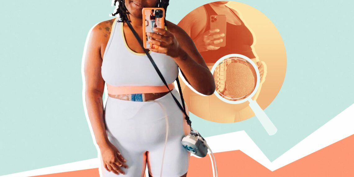 tumor, Chante Burkett, misdiagnosed, gain, medical racism